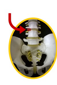 Disc Bulge Sciatica
